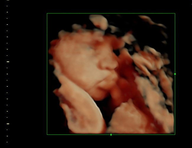 3D ultrasound image at 33 weeks
